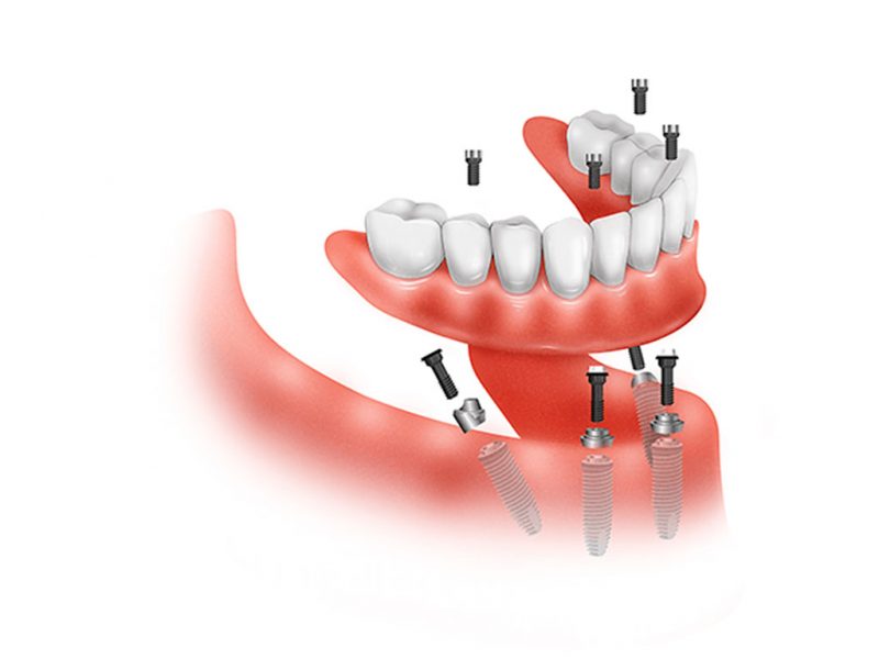Clínica Dental Pio X, implantes