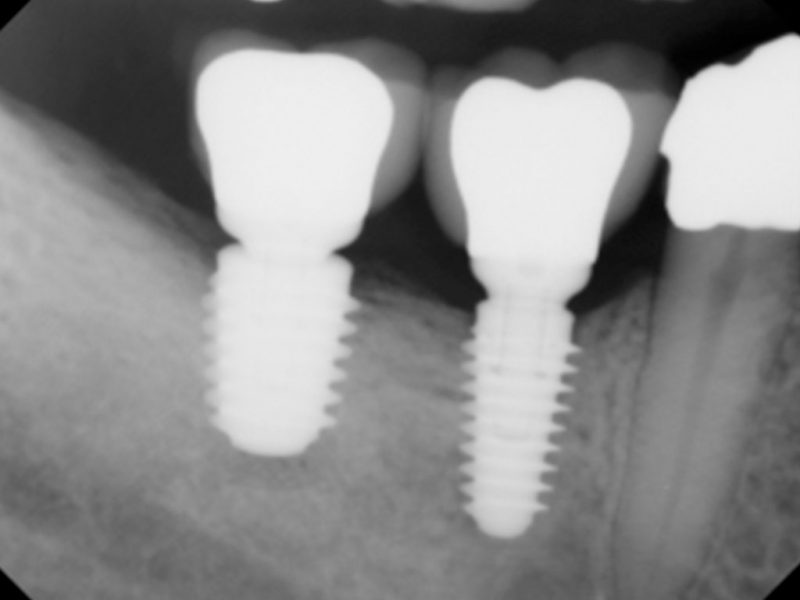 Clínica Dental Pio X, implantes